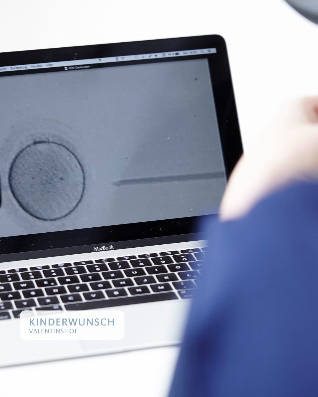 Einblick in die künstliche Befruchtung

Die künstliche Befruchtung, auch als IVF bekannt, bietet Paaren mit unerfülltem Kinderwunsch eine wegweisende Möglichkeit, ihren Traum von einem Kind zu verwirklichen. Im Labor werden Eizellen und Samenzellen unter optimalen Bedingungen zusammengeführt, um eine Befruchtung zu ermöglichen.

Mittels modernster Technologie und einer einfühlsamen Betreuung begleiten wir Sie Schritt für Schritt auf diesem besonderen Weg. In unserer Kinderwunschklinik in Hamburg stehen Sie als Patientin im Mittelpunkt.

Vereinbaren Sie einen Termin und lassen Sie sich von unserem erfahrenen Team begleiten.

#hormone #hormongesundheit #kinderwunsch#kinderwunschhamburg #hamburg #kiwuverbindet #frausein#kinderwunschmythen #schwanger #pregnant #kiwu#kiwukämpferin #kiwucommunity #künstlichebefruchtung#kinderwunsch2026